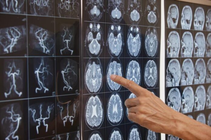 a quick overview on traumatic brain injury causes and treatment